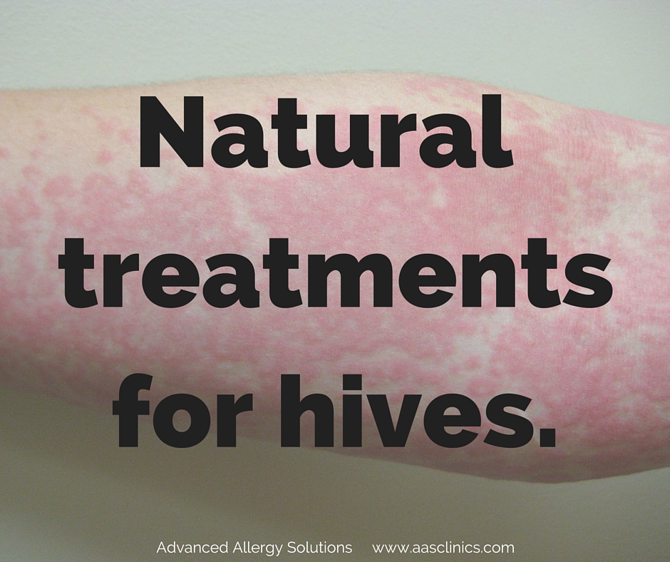 allergic reaction hives home remedies